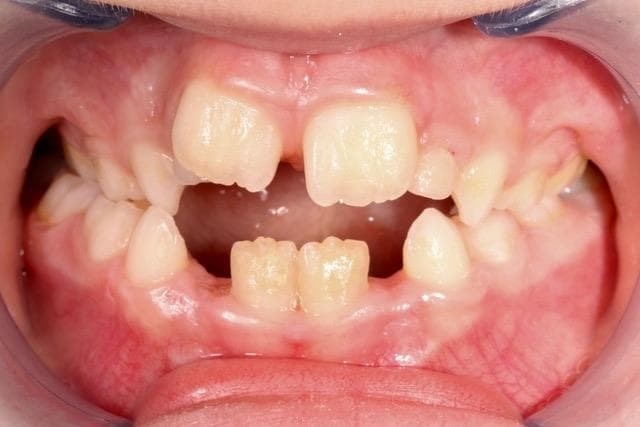 Ortodoncia Infantil - Imagen 4