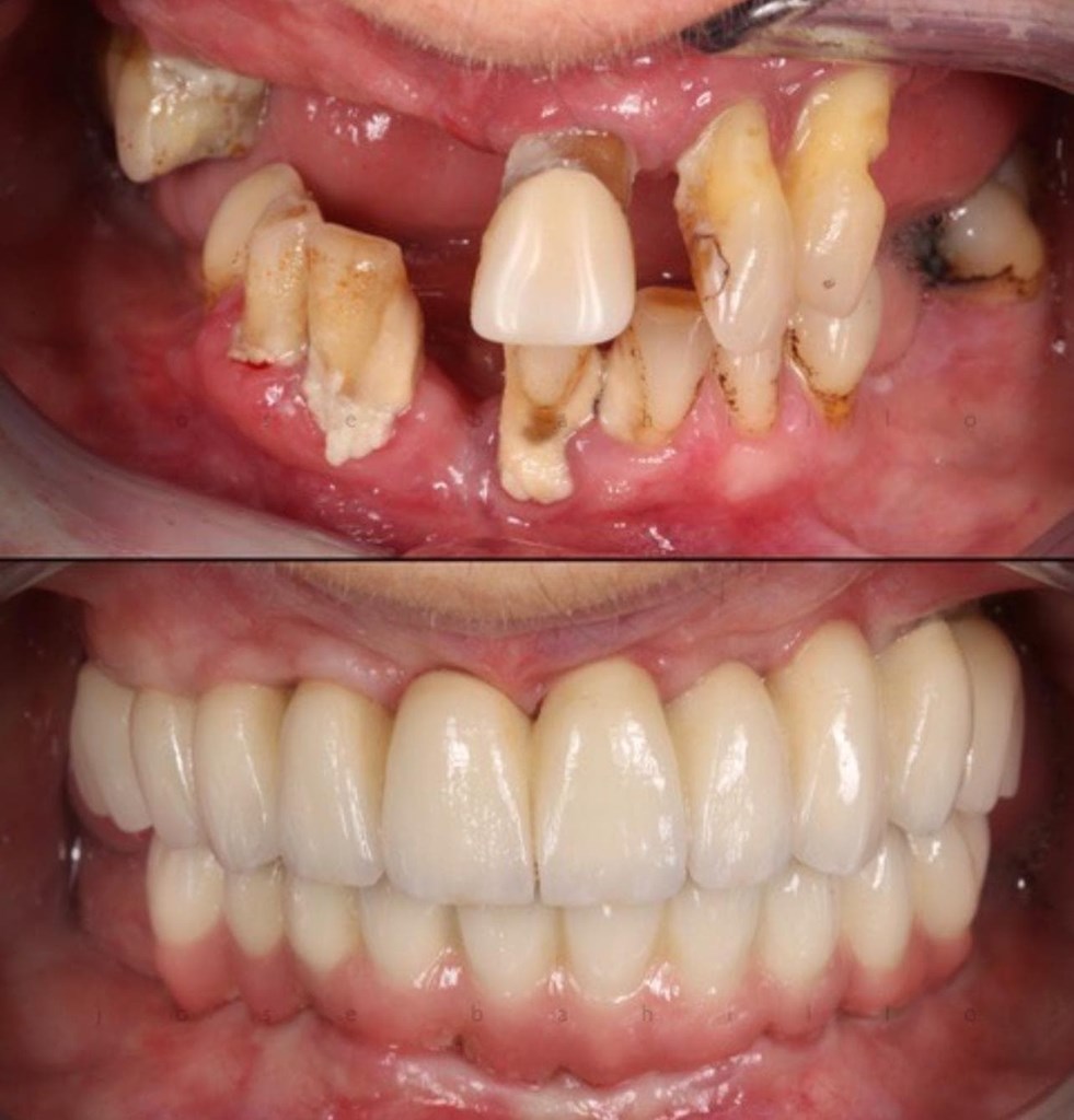 Rehabilitación Oral Total de Casos Extremos