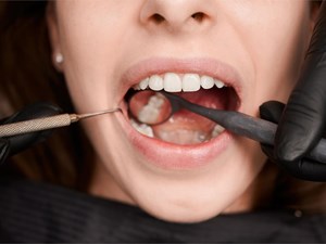4 causas comunes de halitosis y cómo combatirla