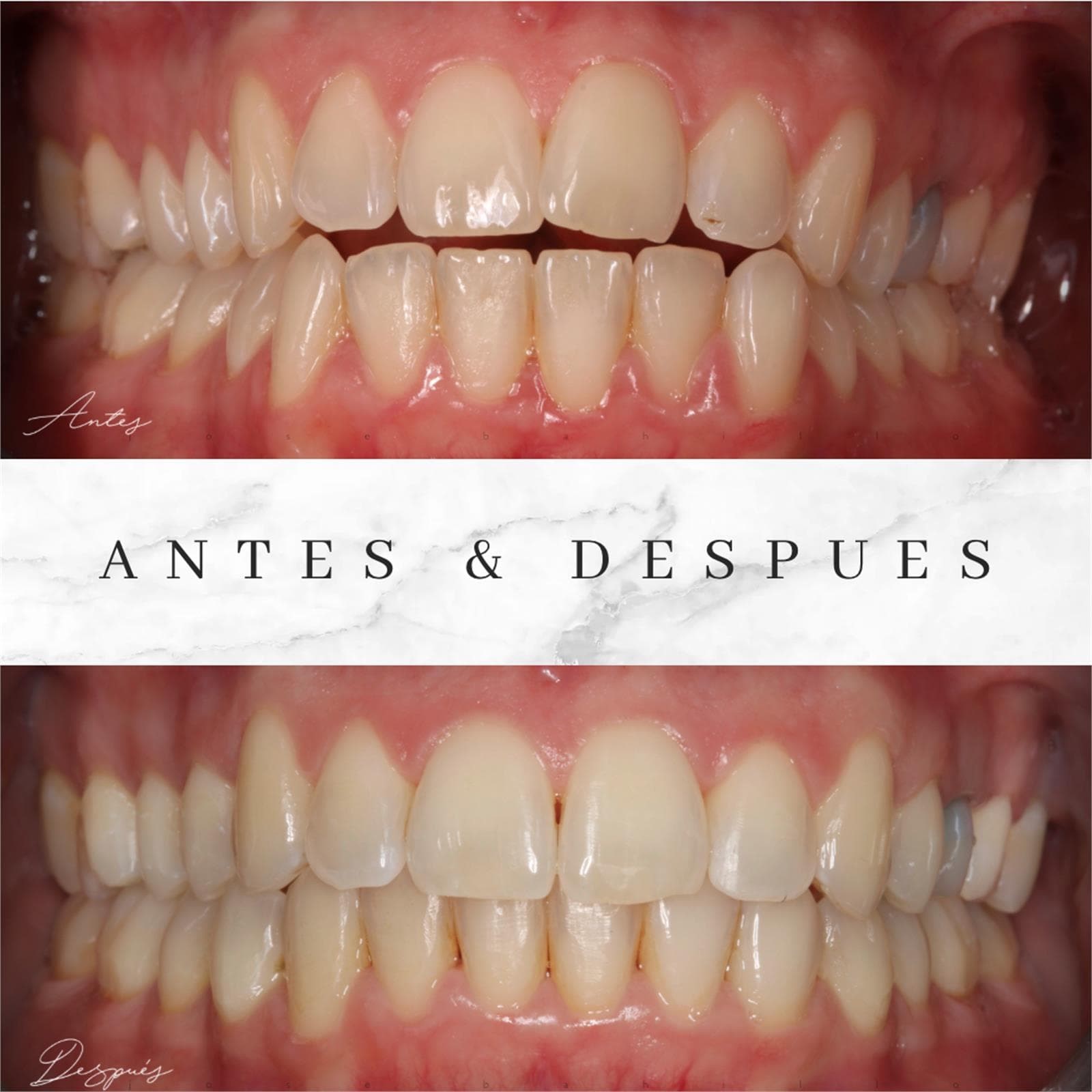 Blanqueamiento dental - Imagen 1