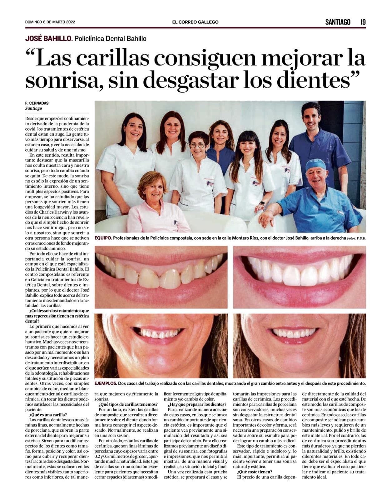 Carillas Dentales en Santiago de Compostela - Imagen 3