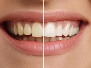 ¿Cuáles son las principales causas del oscurecimiento de los dientes?