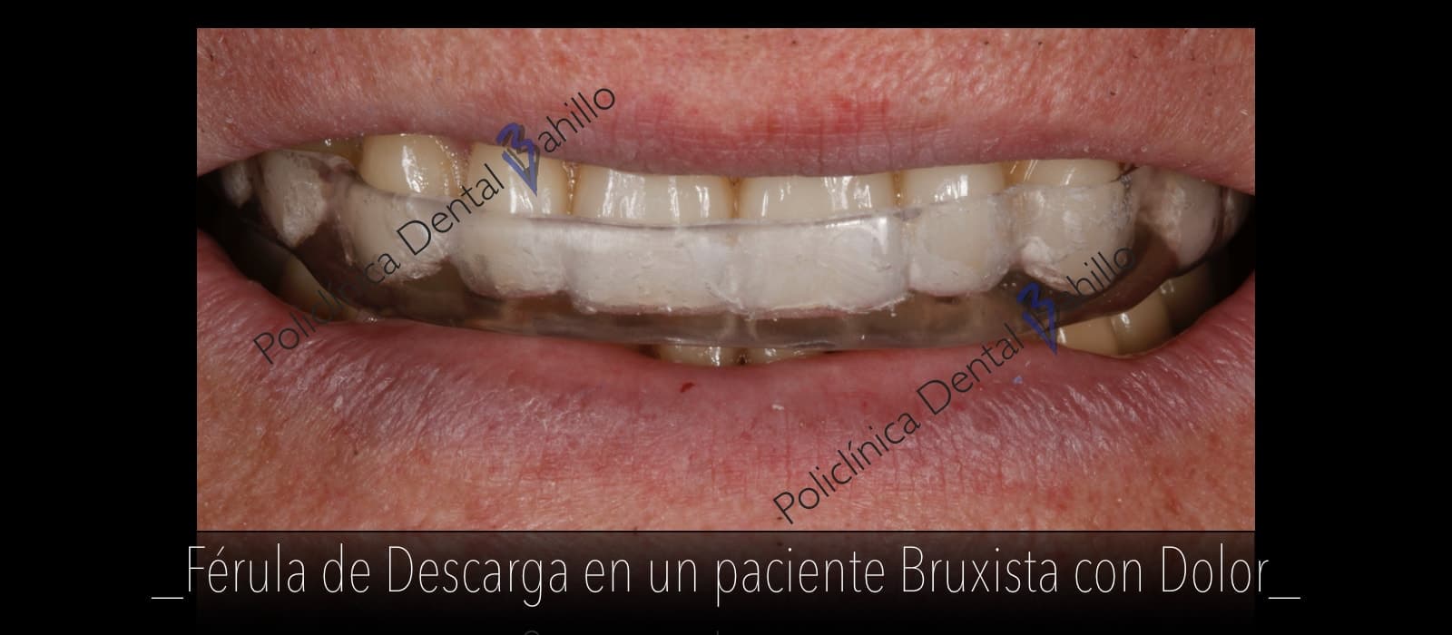 Articulación ATM - Policlínica Dental Bahillo
