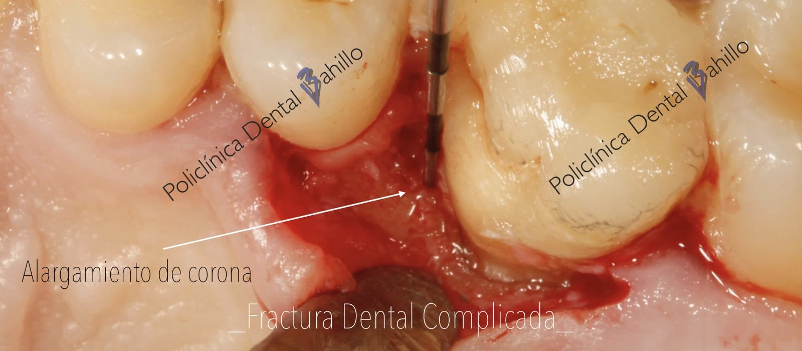 Cirugía - Policlínica Dental Bahillo