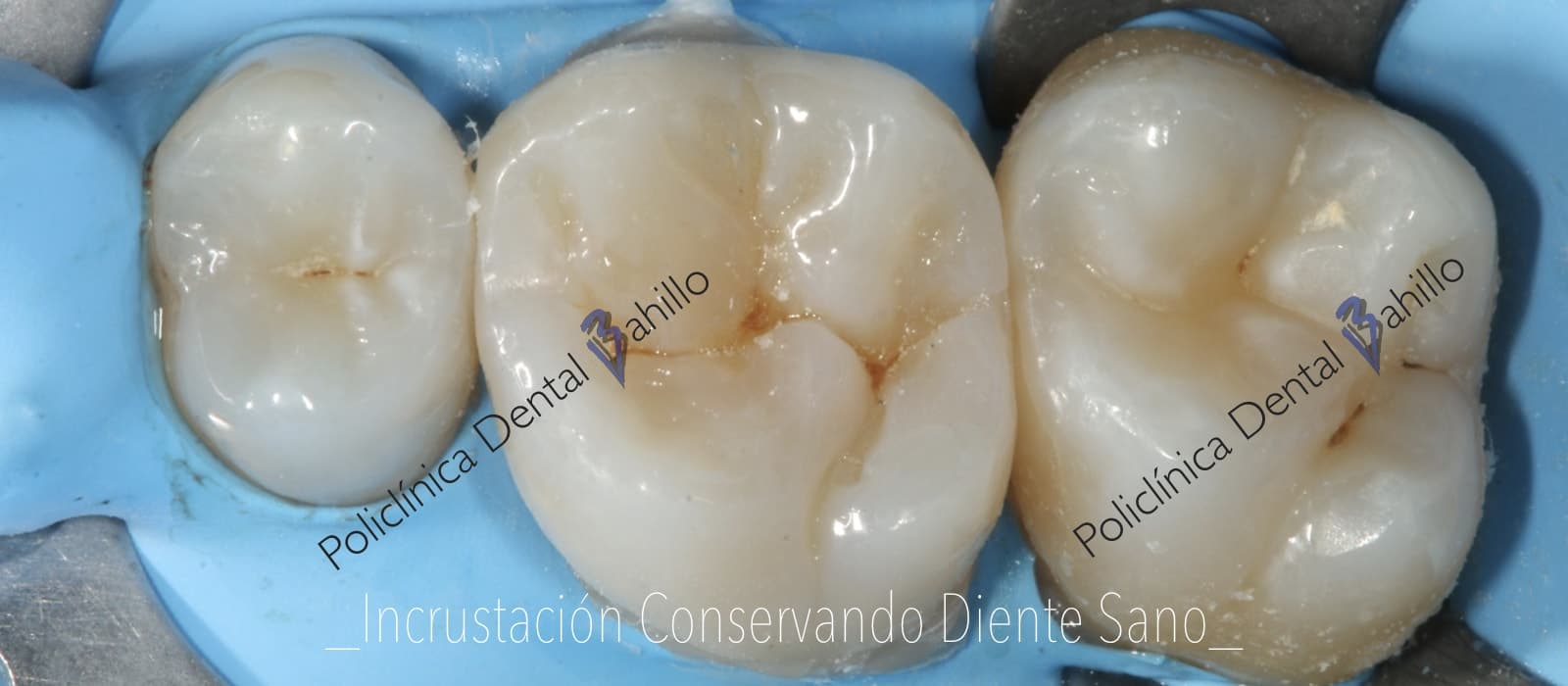Cirugía - Policlínica Dental Bahillo