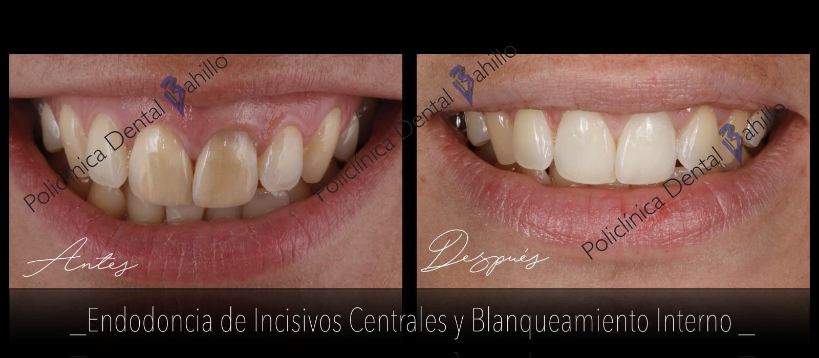 Endodoncia - Policlínica Dental Bahillo