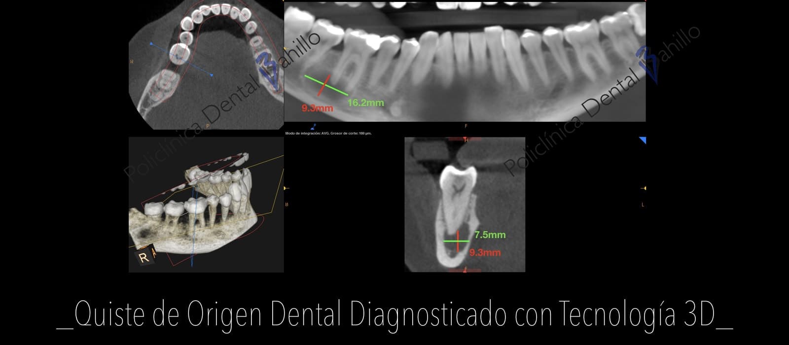 Endodoncia - Policlínica Dental Bahillo
