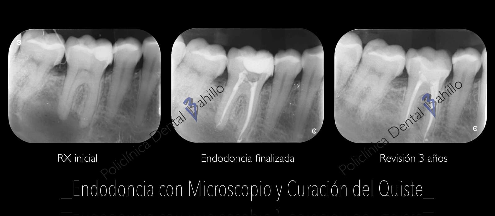 Endodoncia - Policlínica Dental Bahillo