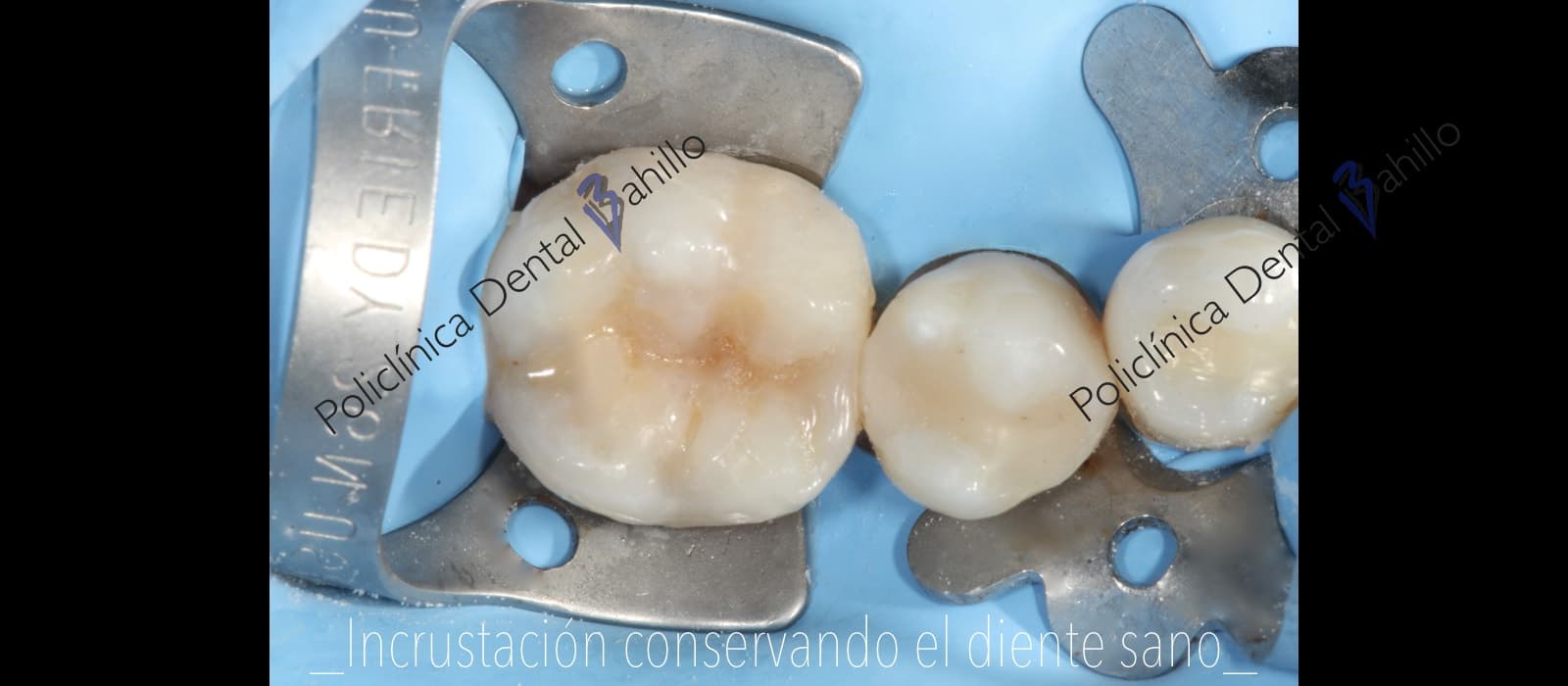 Endodoncia - Policlínica Dental Bahillo