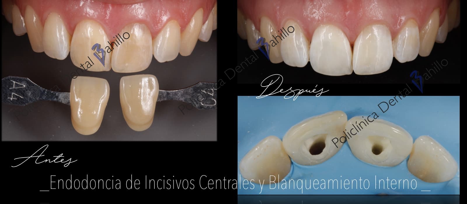 Endodoncia - Policlínica Dental Bahillo