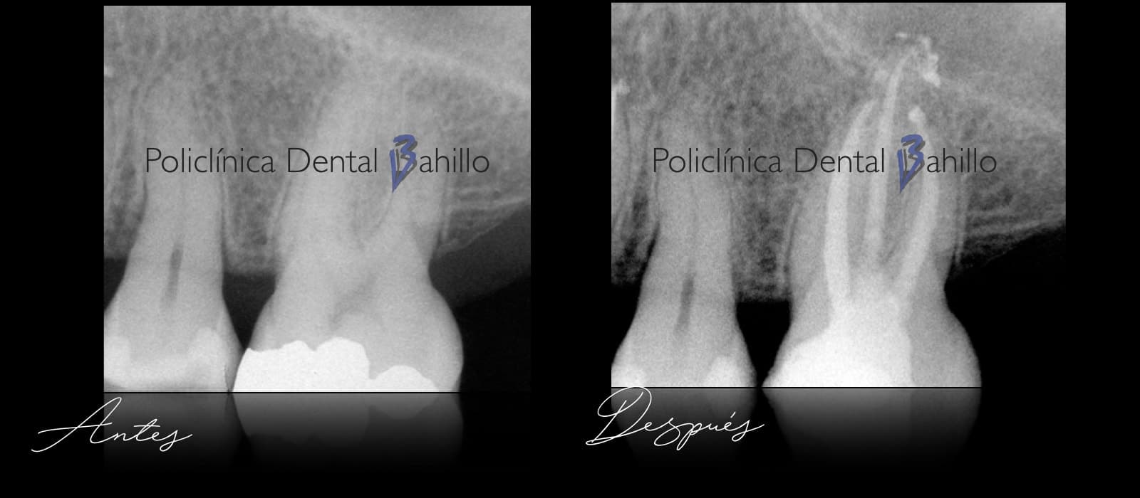 Endodoncia - Policlínica Dental Bahillo