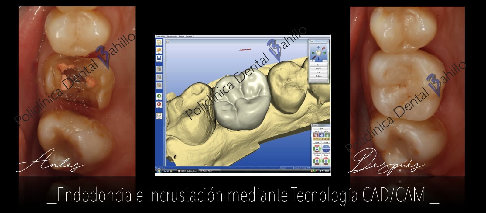 Endodoncia - Policlínica Dental Bahillo