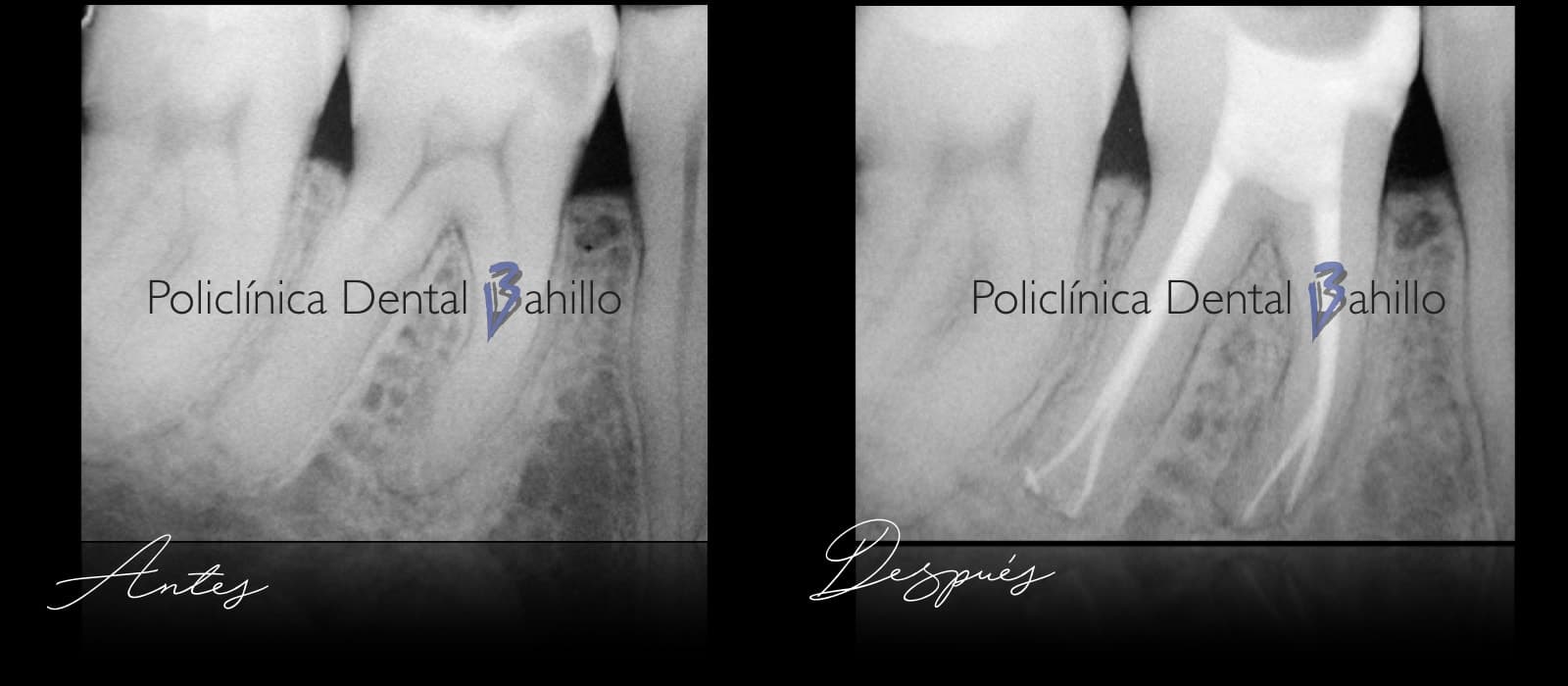 Endodoncia - Policlínica Dental Bahillo