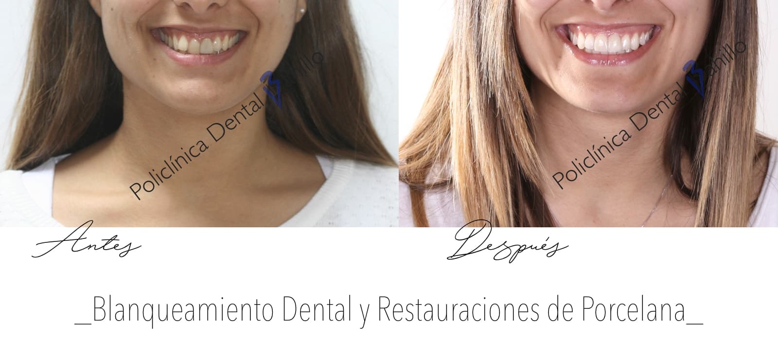 Estética dental - Policlínica Dental Bahillo