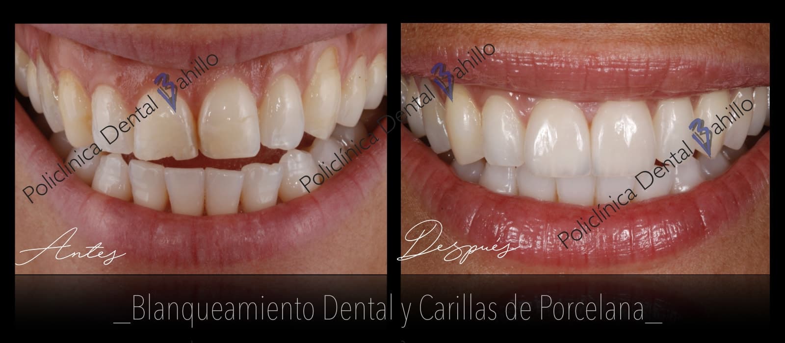 Estética dental - Policlínica Dental Bahillo