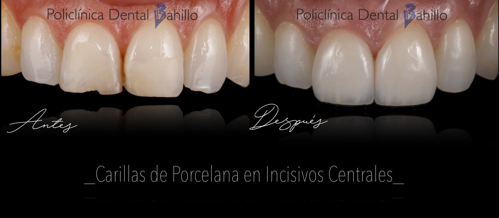Estética dental - Policlínica Dental Bahillo