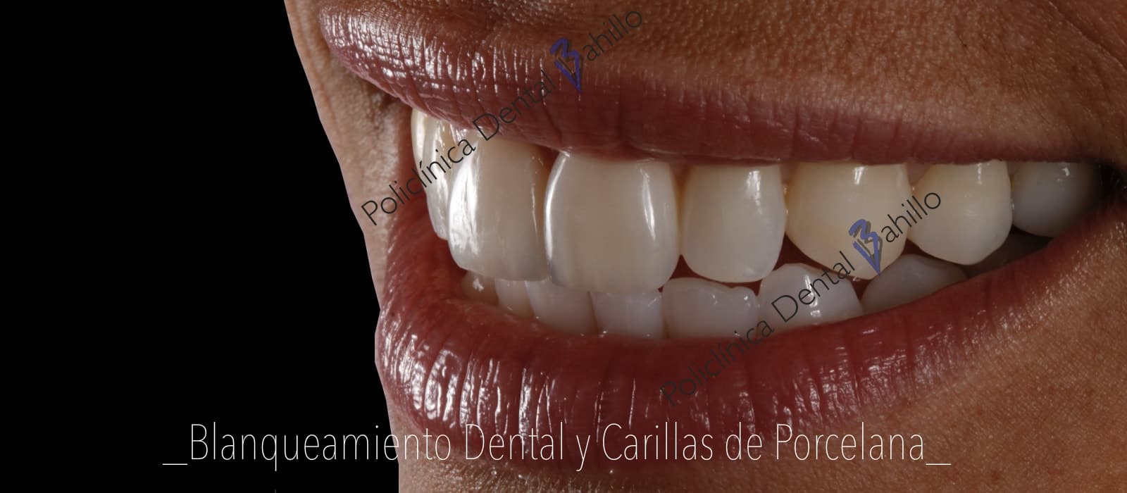 Estética dental - Policlínica Dental Bahillo