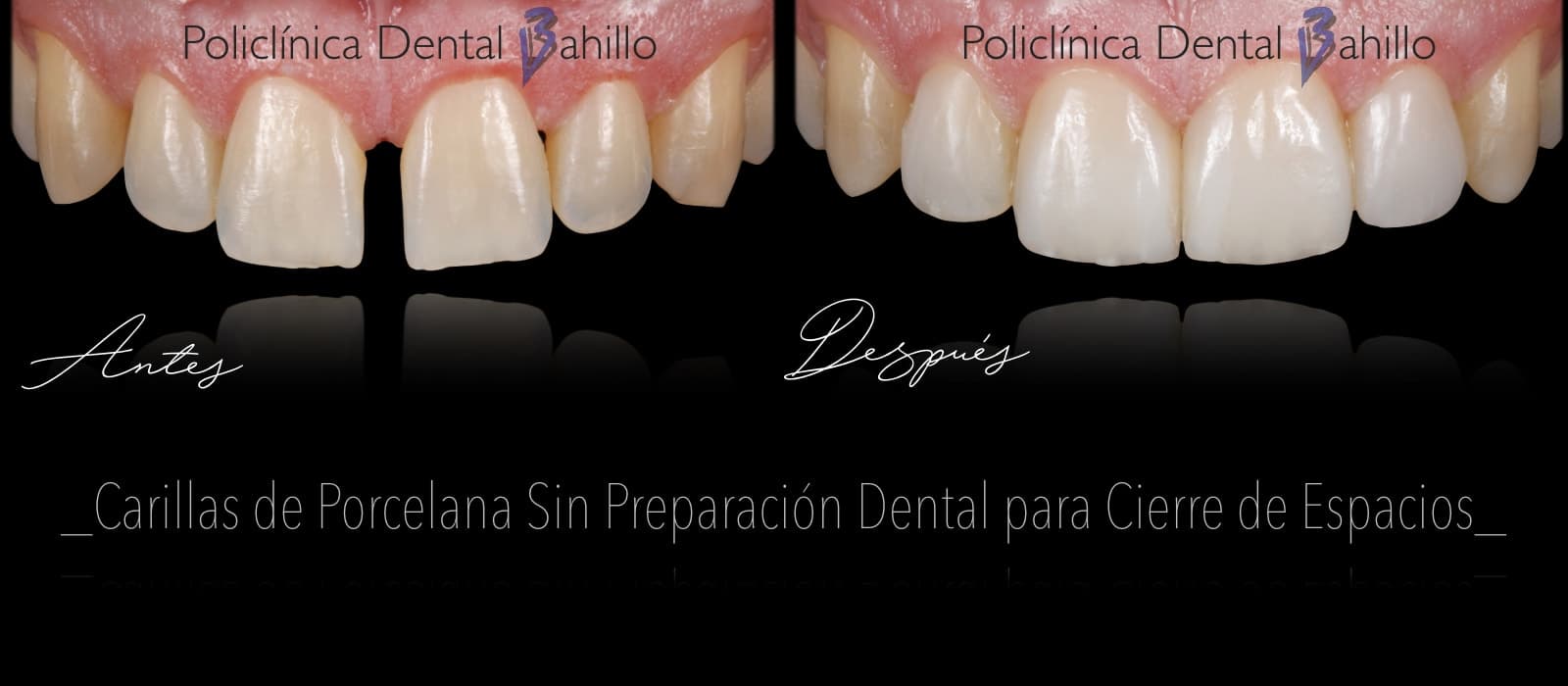 Estética dental - Policlínica Dental Bahillo