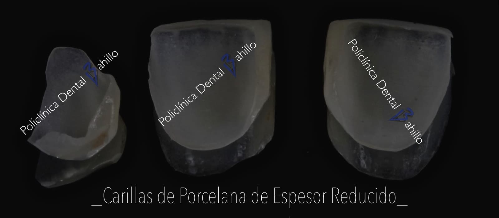 Estética dental - Policlínica Dental Bahillo