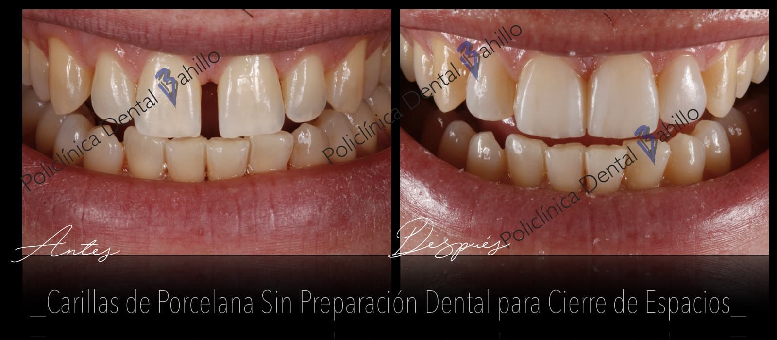 Estética dental - Policlínica Dental Bahillo