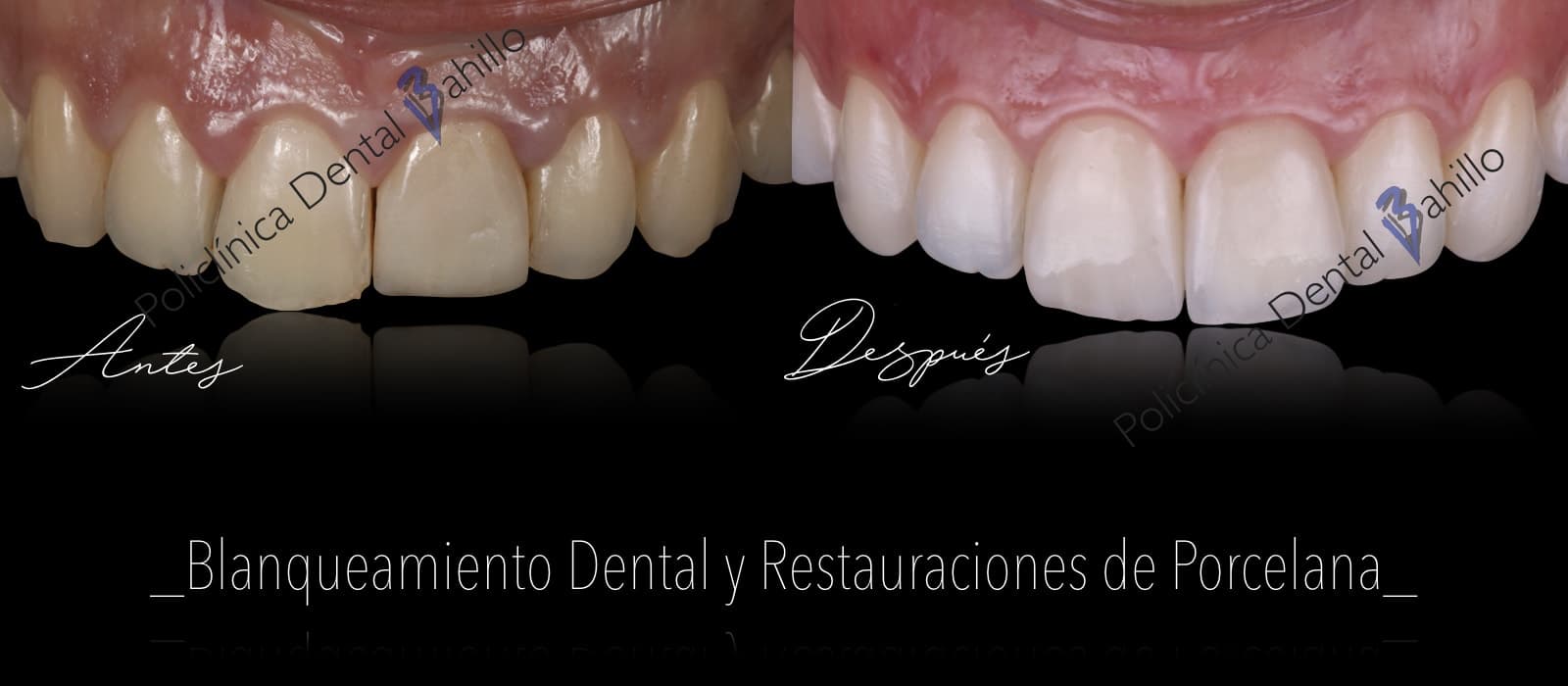 Estética dental - Policlínica Dental Bahillo