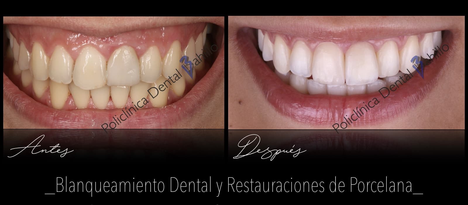 Estética dental - Policlínica Dental Bahillo