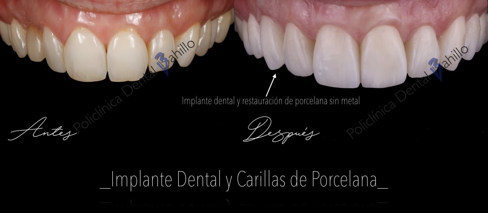 Implantología - Policlínica Dental Bahillo