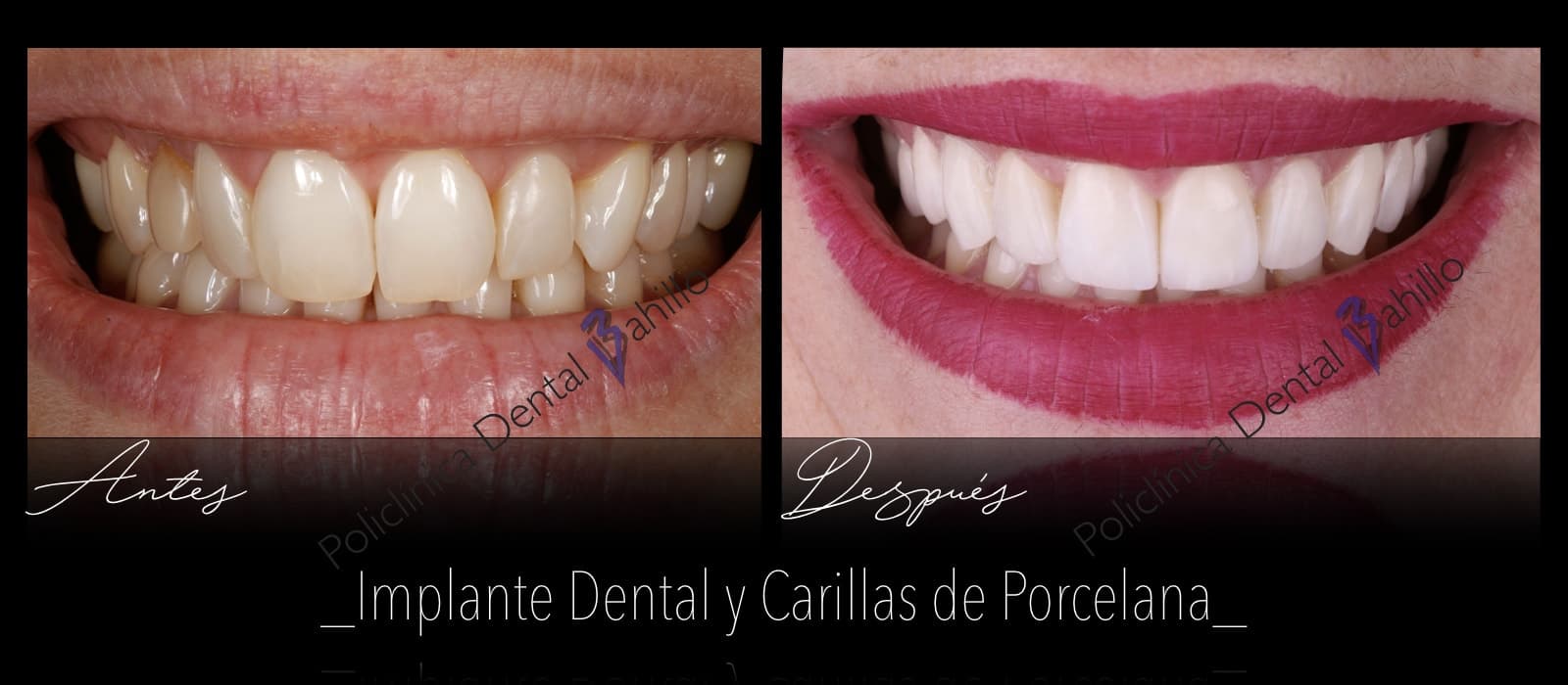 Implantología - Policlínica Dental Bahillo