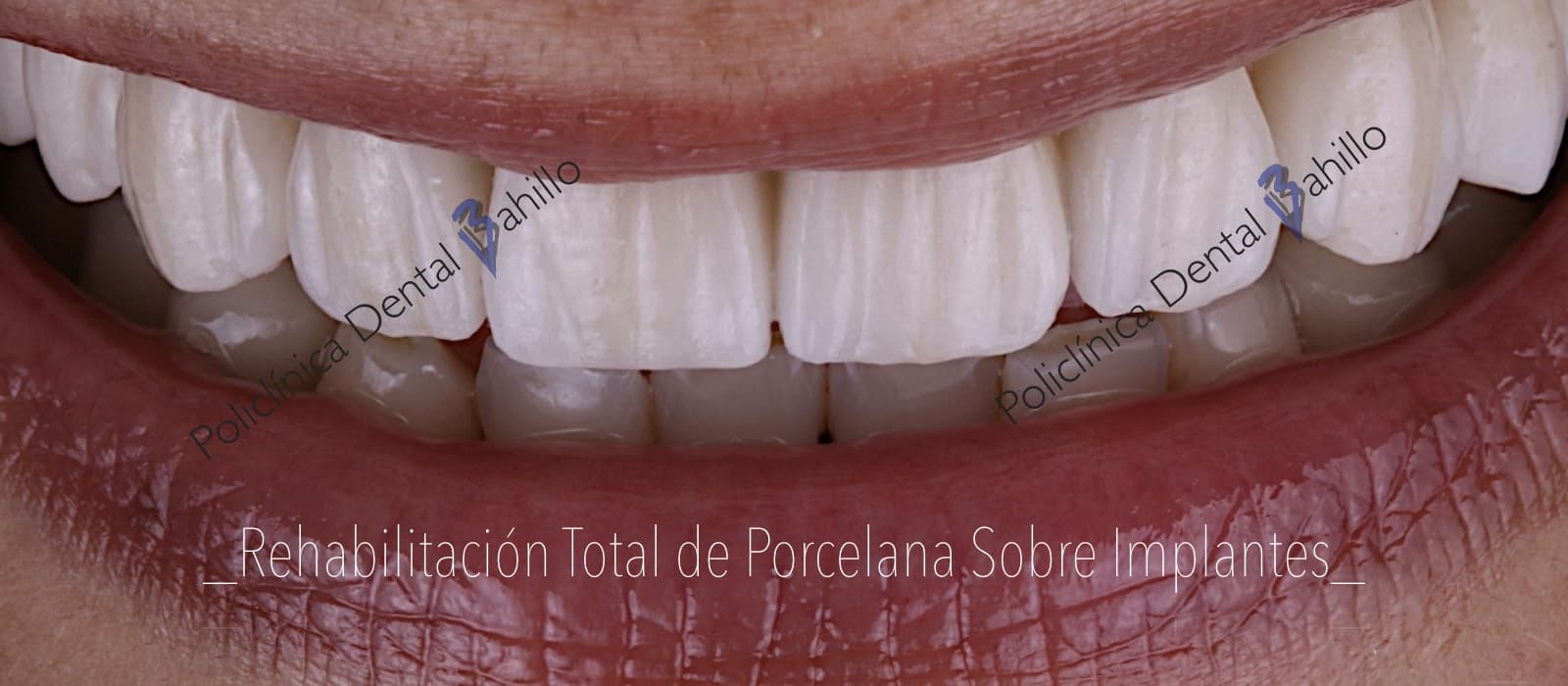 Implantología - Policlínica Dental Bahillo