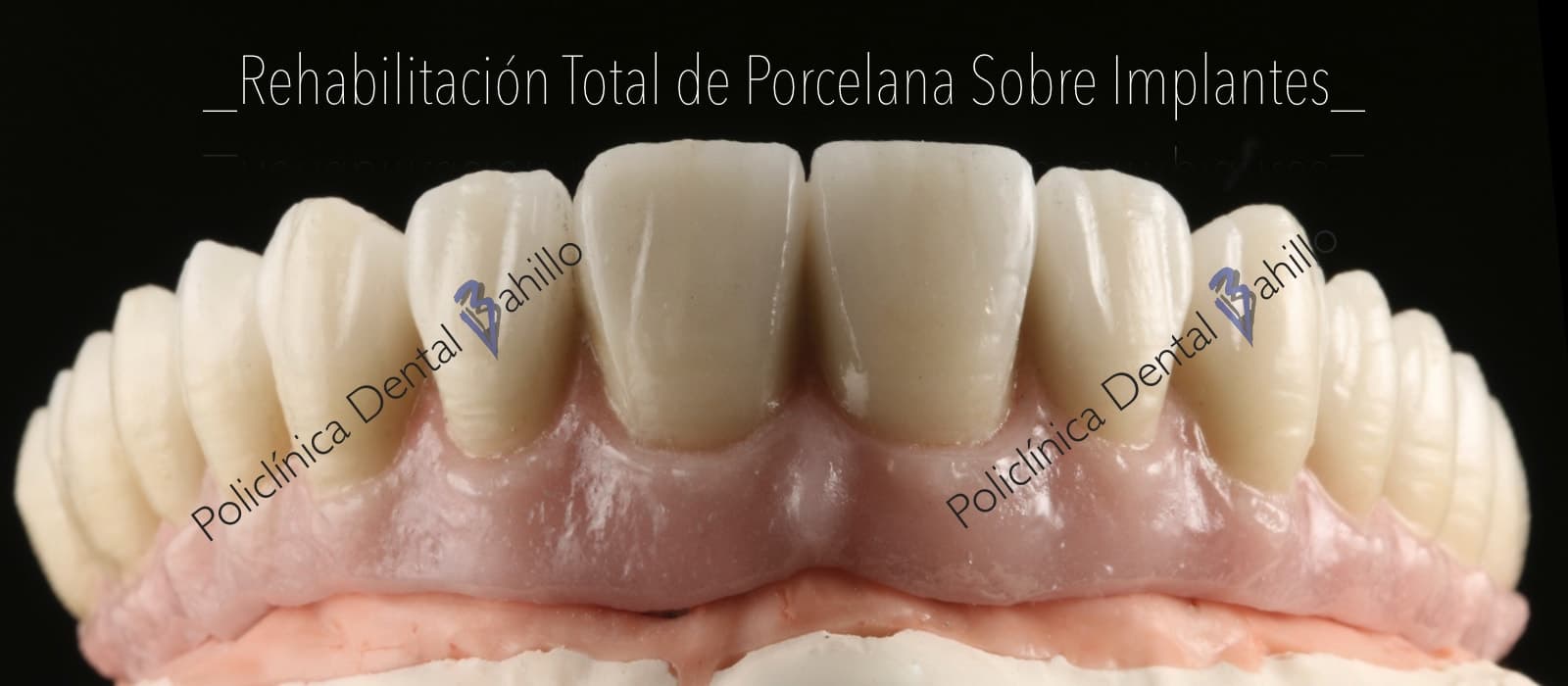 Implantología - Policlínica Dental Bahillo