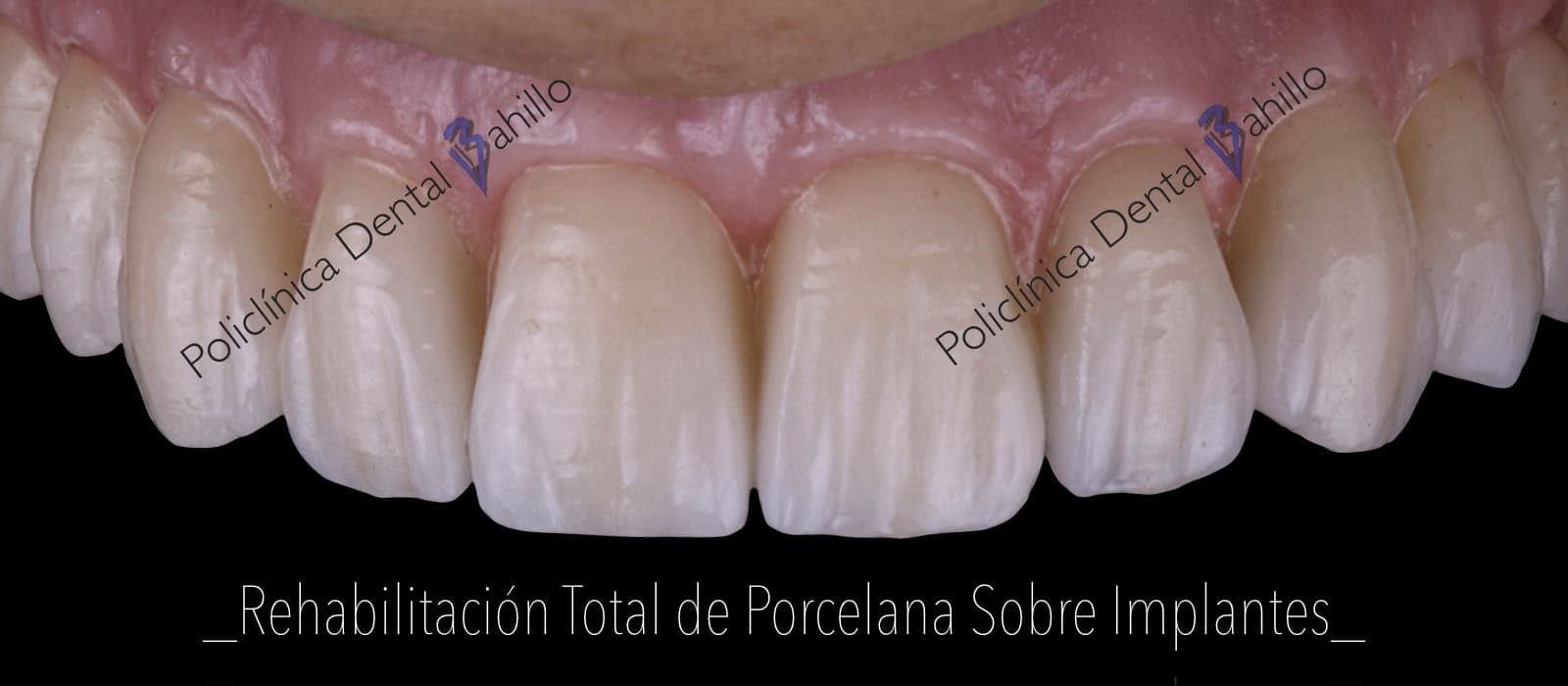 Implantología - Policlínica Dental Bahillo