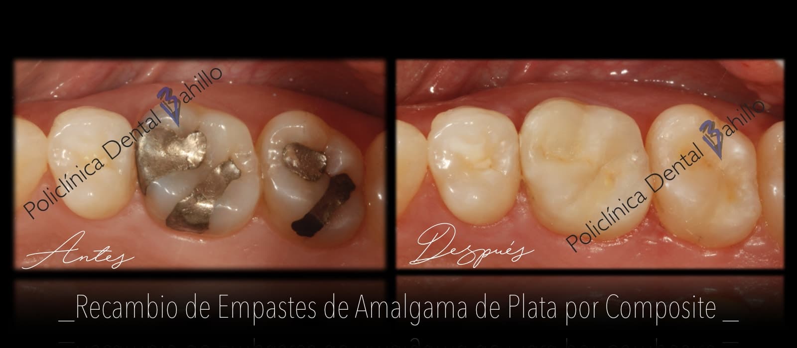 Odontología conservadora - Policlínica Dental Bahillo