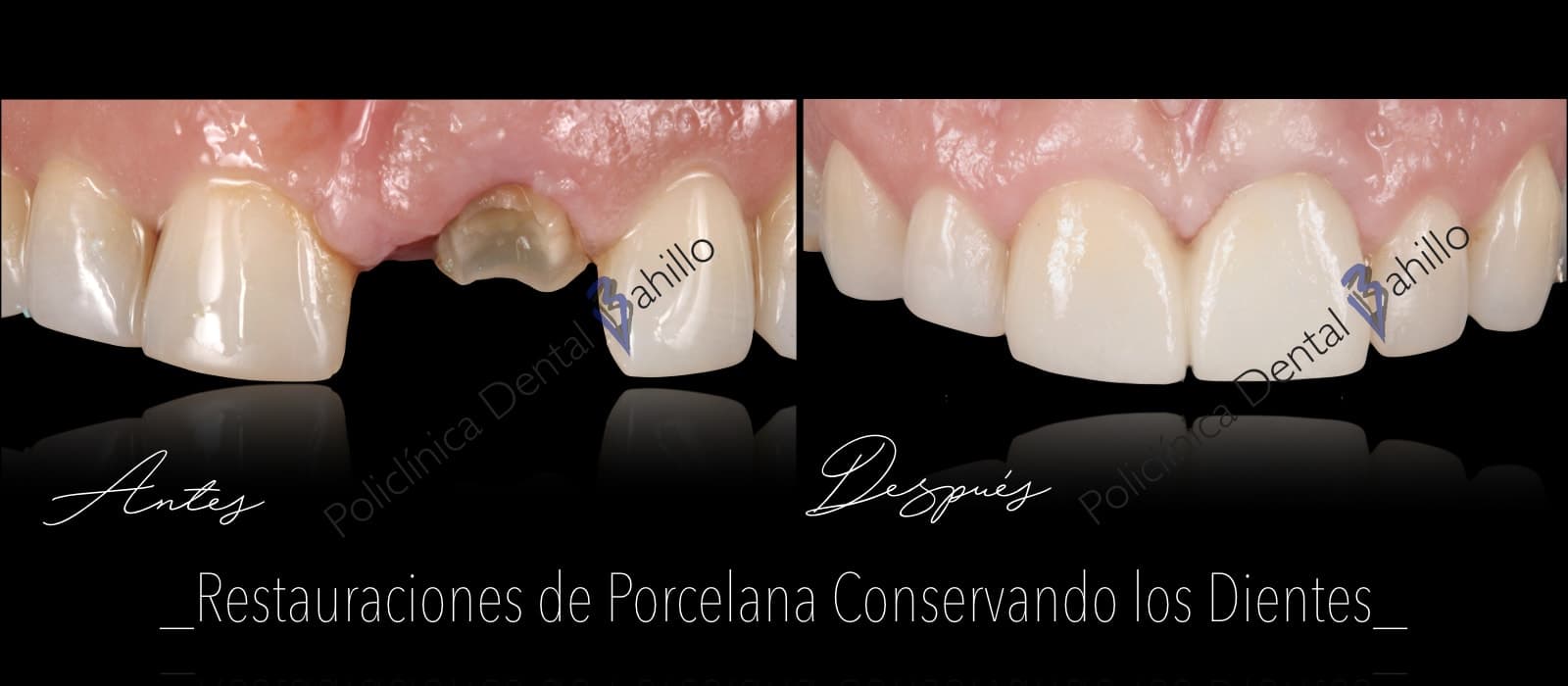 Odontología conservadora - Policlínica Dental Bahillo
