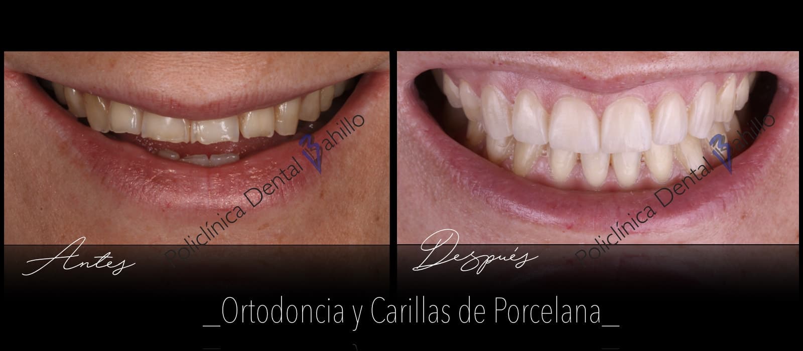 Ortodoncia - Policlínica Dental Bahillo