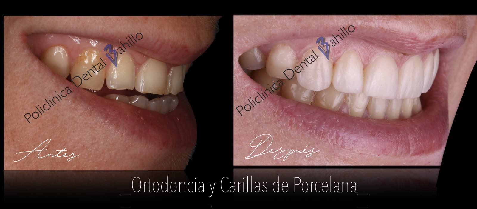 Ortodoncia - Policlínica Dental Bahillo