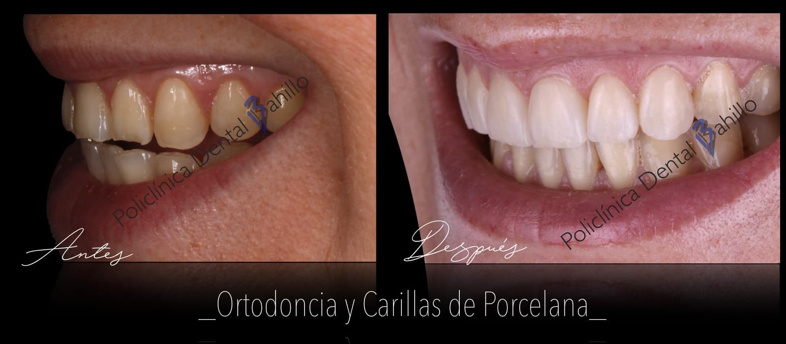 Ortodoncia - Policlínica Dental Bahillo
