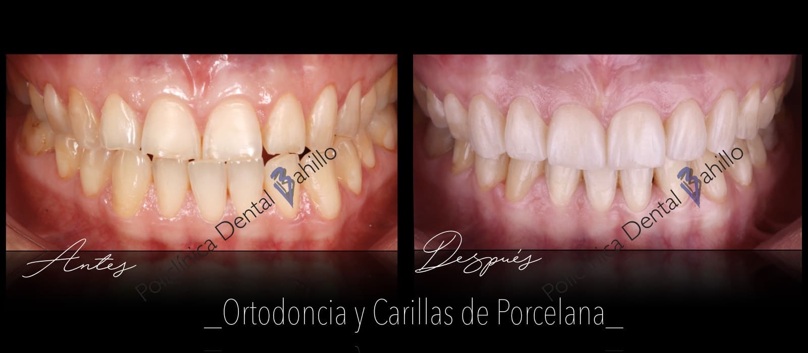 Ortodoncia - Policlínica Dental Bahillo