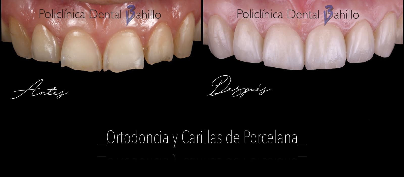 Ortodoncia - Policlínica Dental Bahillo