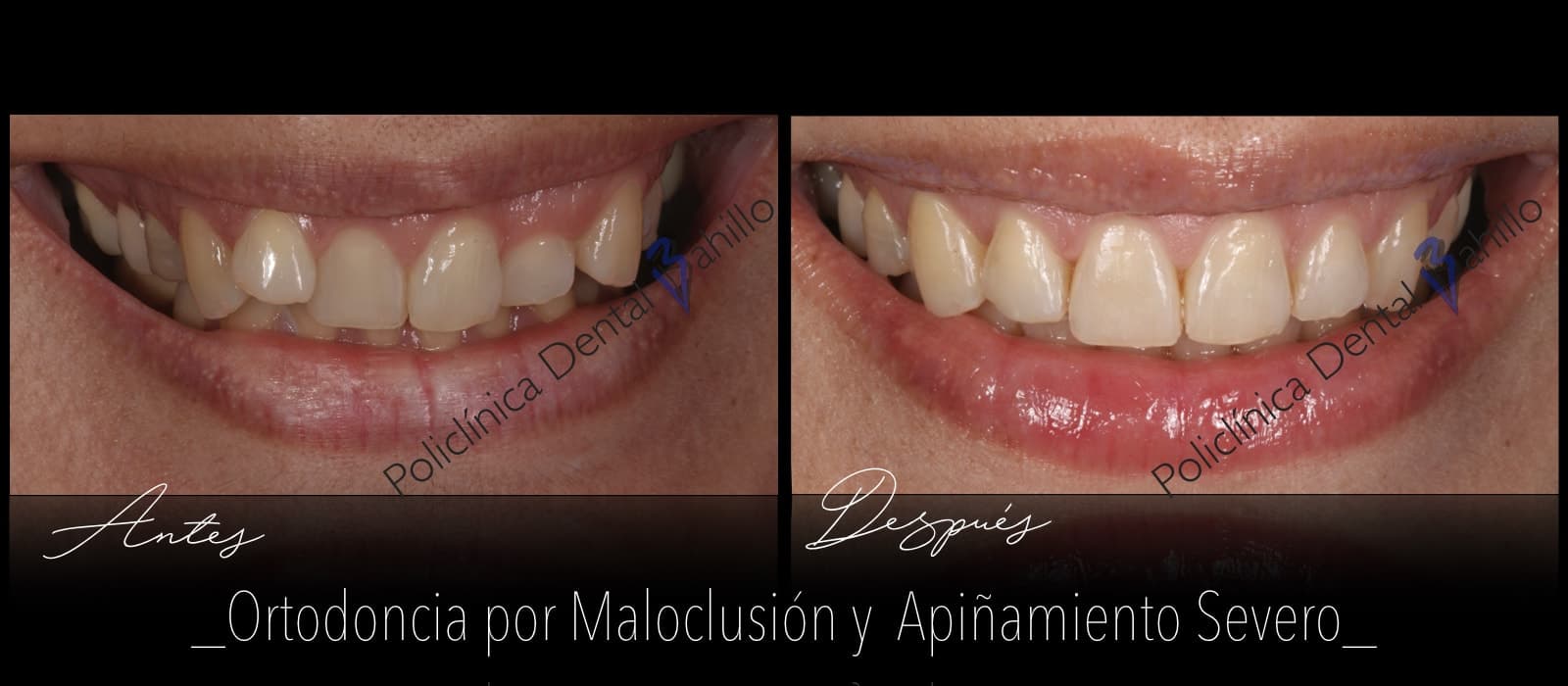 Ortodoncia - Policlínica Dental Bahillo