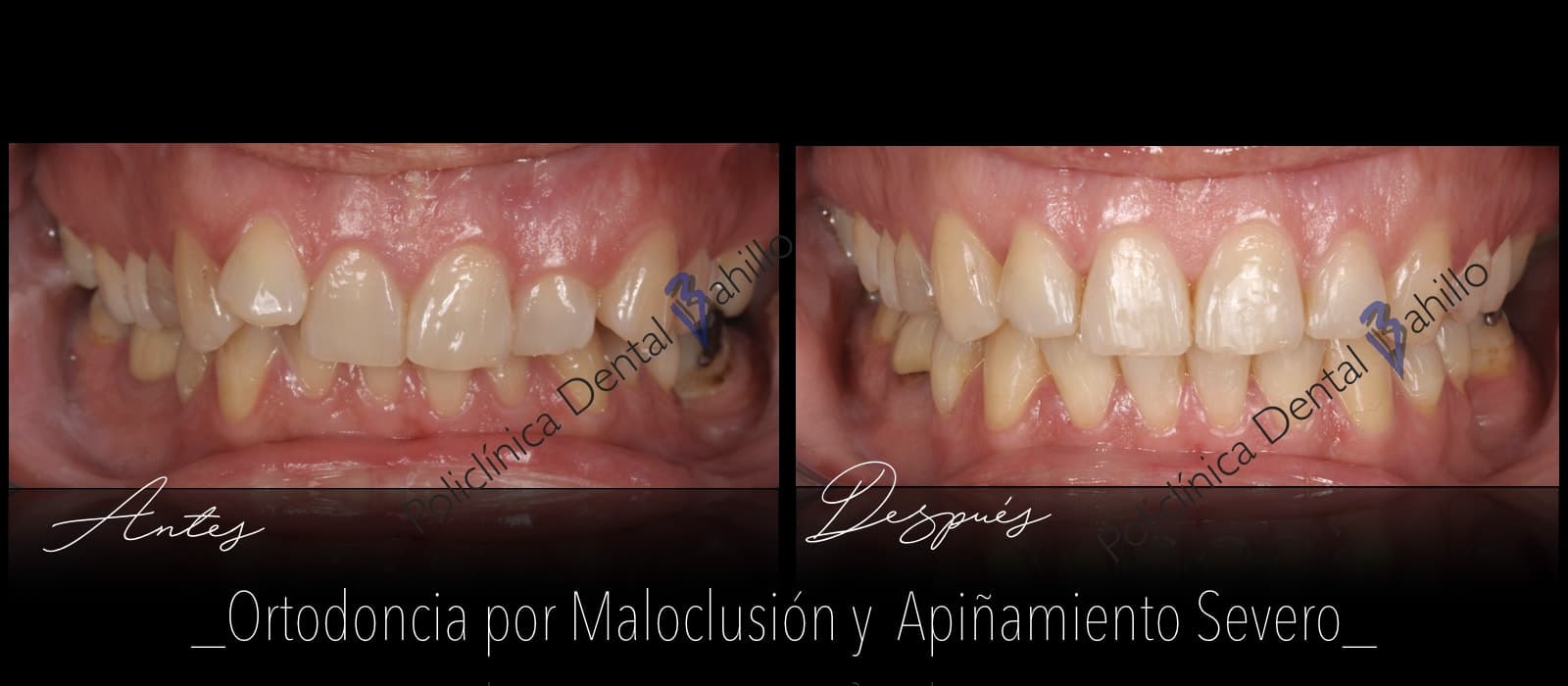 Ortodoncia - Policlínica Dental Bahillo
