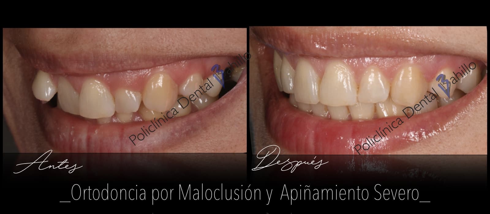Ortodoncia - Policlínica Dental Bahillo