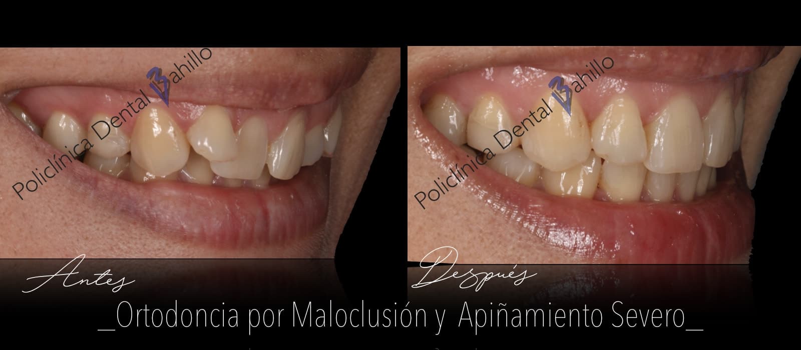 Ortodoncia - Policlínica Dental Bahillo