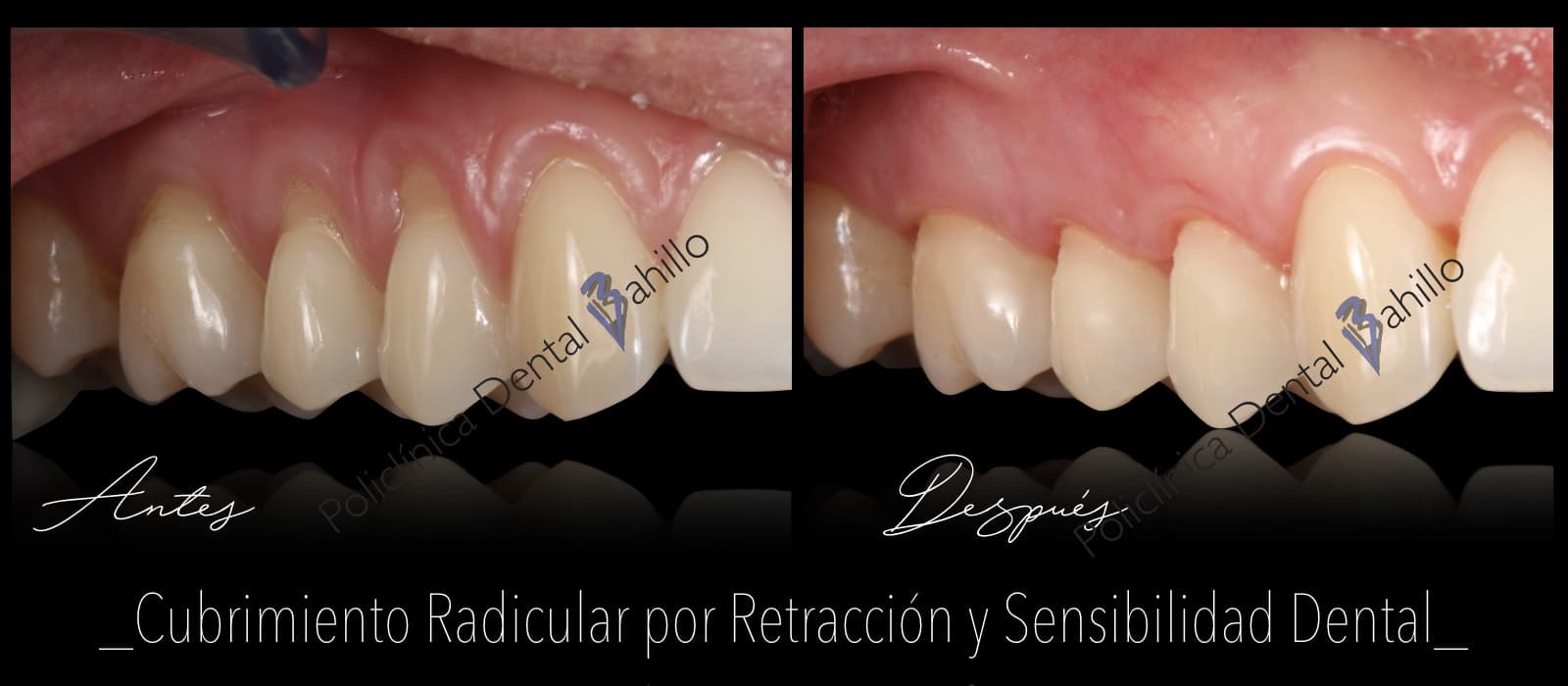Periodoncia - Policlínica Dental Bahillo