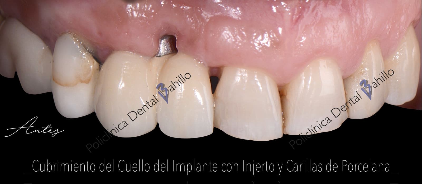 Periodoncia - Policlínica Dental Bahillo