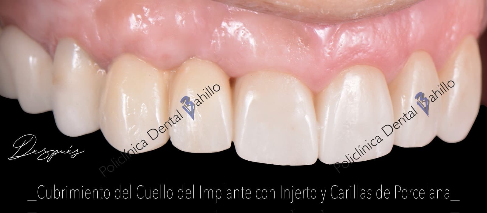 Periodoncia - Policlínica Dental Bahillo
