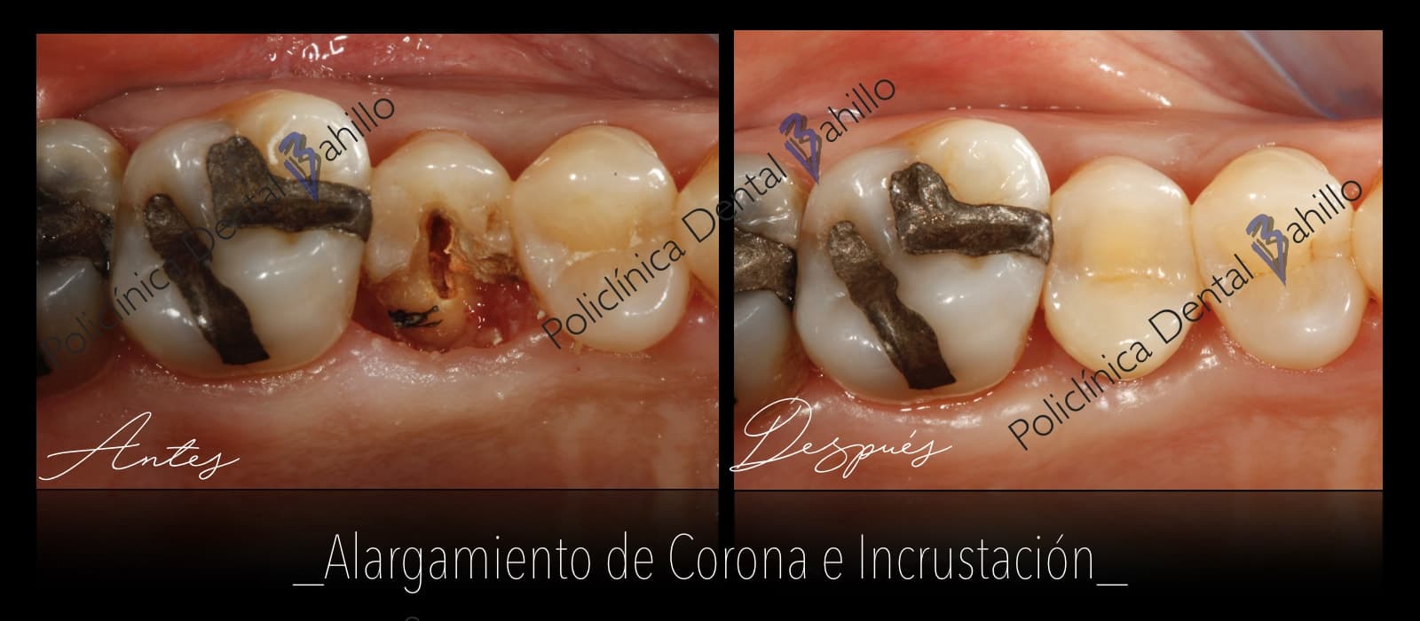 Periodoncia - Policlínica Dental Bahillo