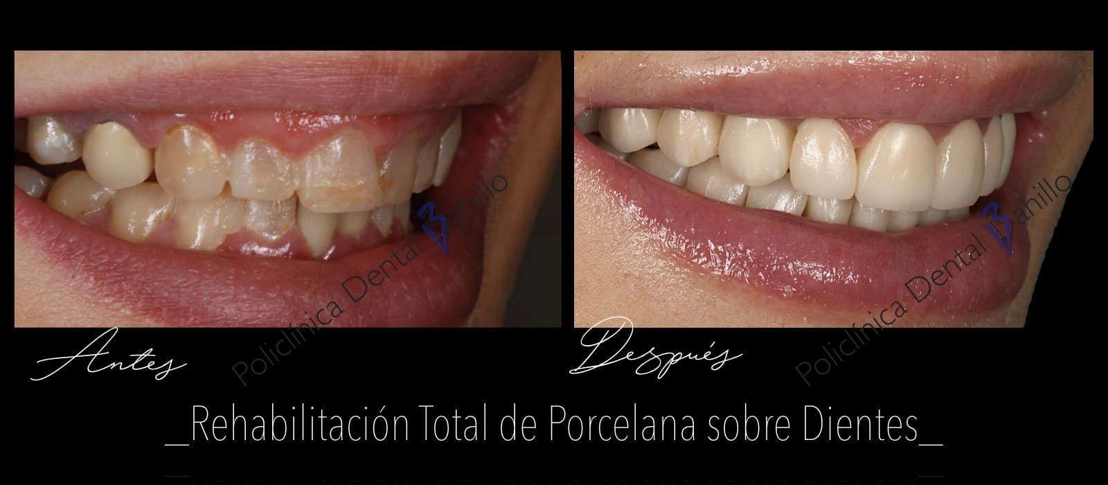 Rehabilitación completa - Policlínica Dental Bahillo