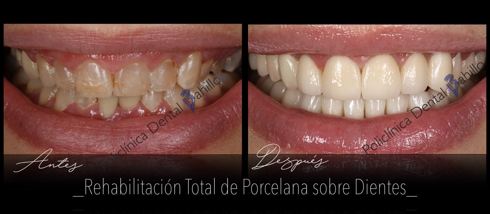 Rehabilitación completa - Policlínica Dental Bahillo