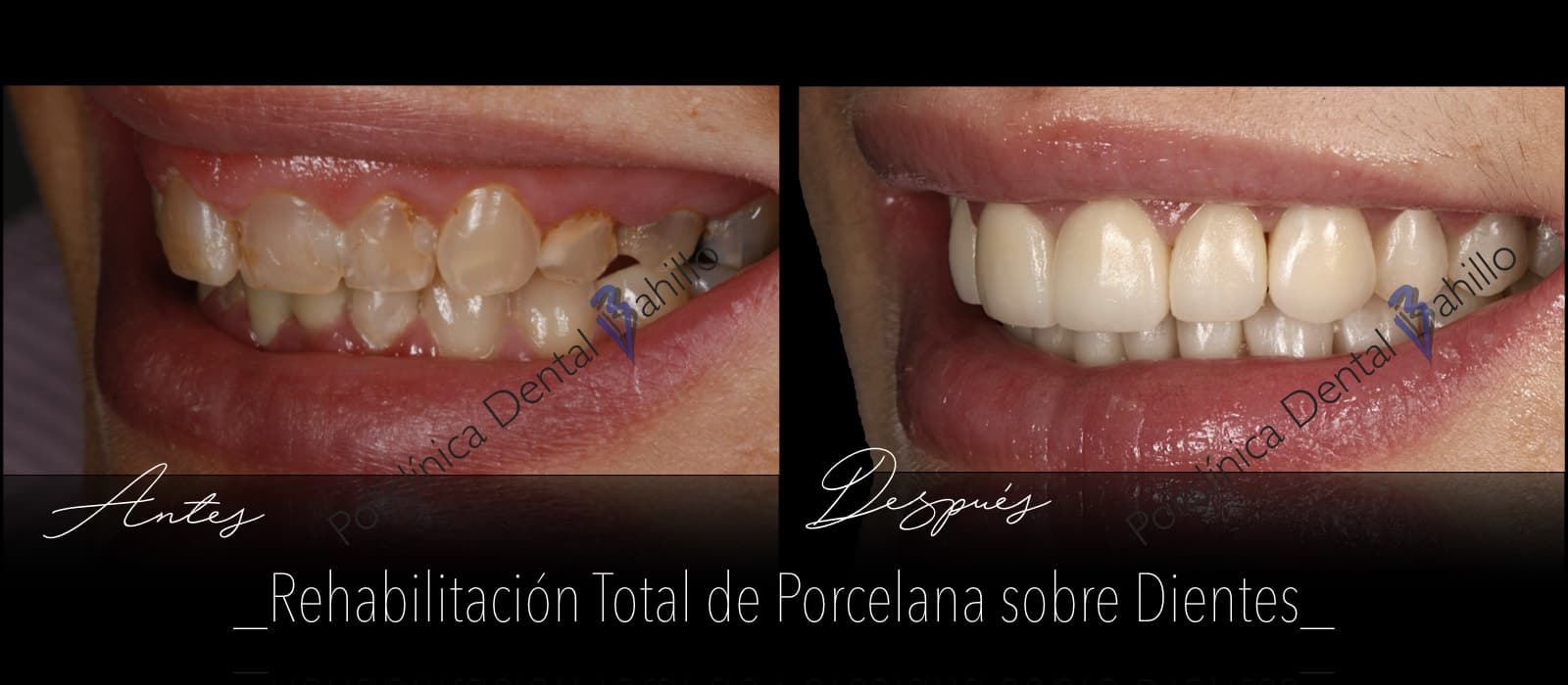 Rehabilitación completa - Policlínica Dental Bahillo