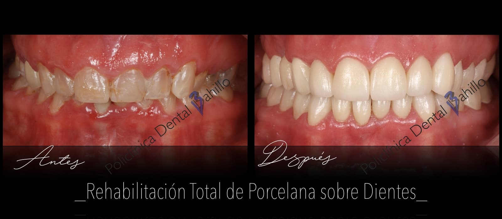 Rehabilitación completa - Policlínica Dental Bahillo